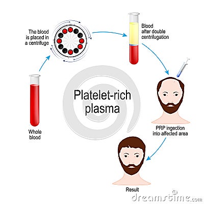 Platelet-rich plasma. PRP Hair Therapy. Medical procedure Vector Illustration